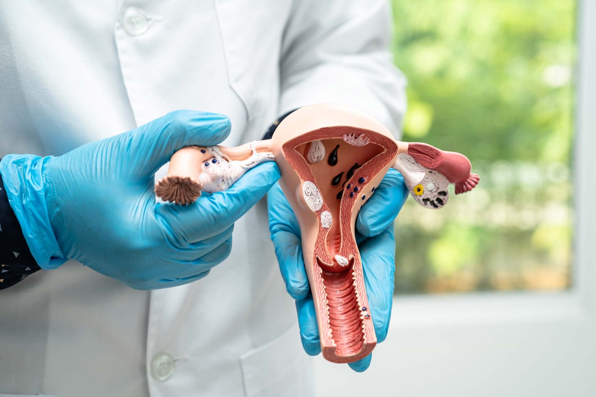 Υποβλεννογόνια ινομυώματα μήτρας